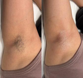 Депиляция воском