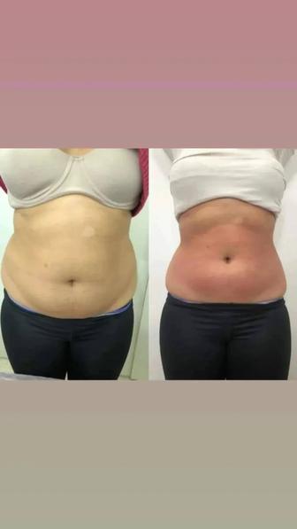 Аппаратный коррекция фигуры