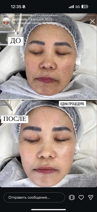 Ультразвуковая чистка лица