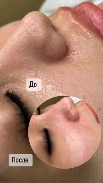 глубокая чистка лица, механическая+аквачистка+ультразвуковая+пилинг