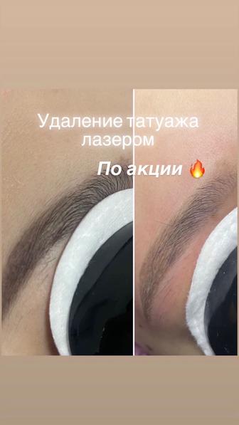 Удаление татуажа