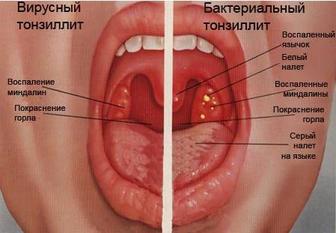 Ангина емдеу