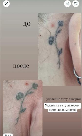 Удаление татуажа и тату