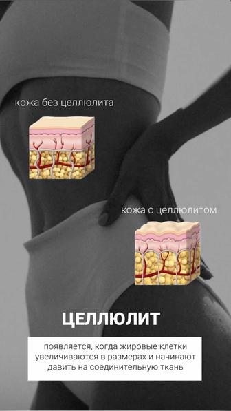 Антицеллюлитная коррекция фигуры
