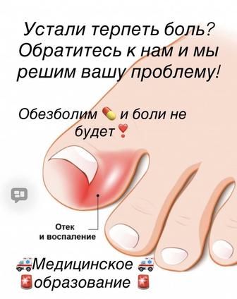 Вросший ноготь, лечение ногтей. Подология.