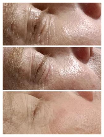 Омоложение холодной плазмой и лазерная эпиляция