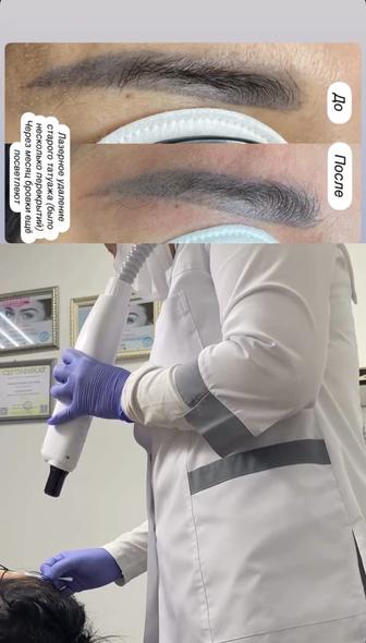 Удаление татуажа