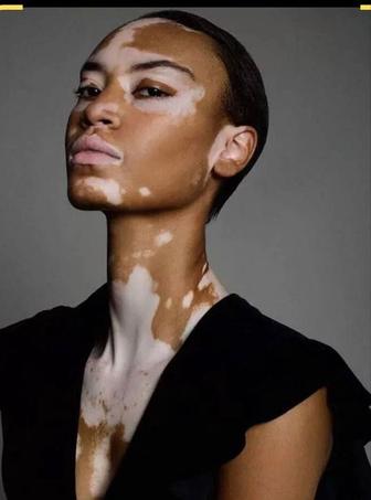 Услуга камуфлирования витилиго