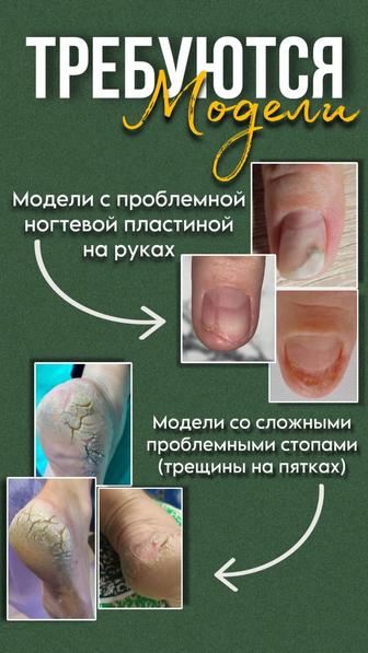 Требуется модели, с проблемными ногтями на руках, и стопами