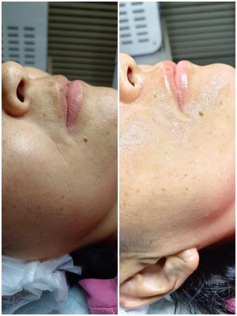 Чистка лица, пилинг, косметологические услуги