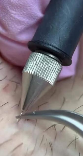 Электроэпиляция