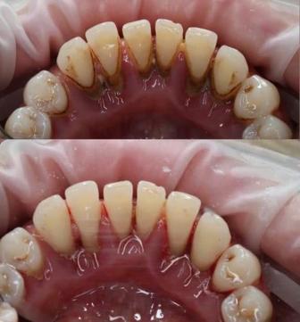 Профессиональная чистка зубов