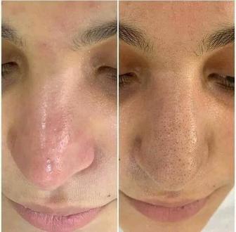 Чистка лица косметолог