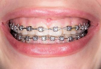 Брекет установка