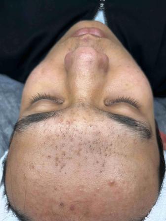 Чистка лица