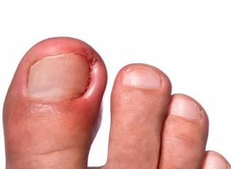 лечение вросших ногтей