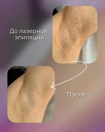 Лазерная эпиляция пришахтинск