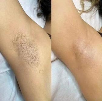 Лазерная эпиляция Удаление волос навсегда