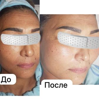 Подтяжка лица