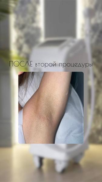 Лазерная эпиляция