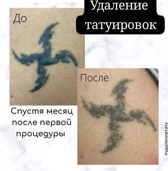 Удаление татуировок и татуажа Алматы 1