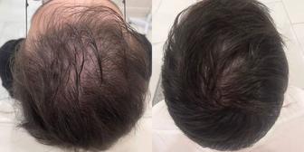 Плазмолифтинг , плазма в волосы , бороду