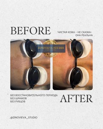 Удаление любого серого, синего татуажа/ перманента или некачественной тату