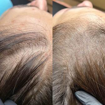 ТРИХОПИГМЕНТАЦИЯ