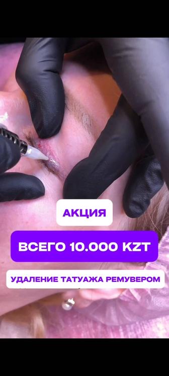 Удаление татутажа ремувером и лазером