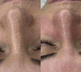 Чистка лица