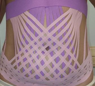 Коррекция фигуры кинезио тейпами