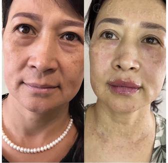 Горячая плазма (оригинальный аппарат)