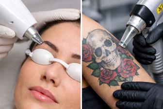 Лазерное удаление татуировок и татуажа