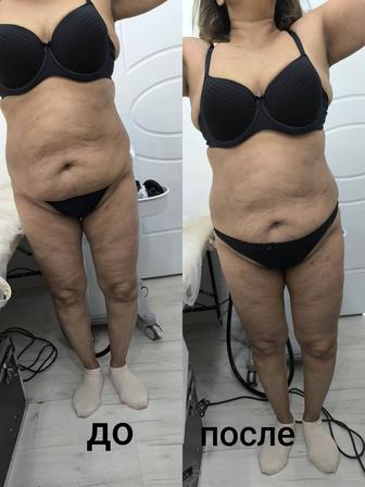 Похудение на аппарате вакуум кавитация!