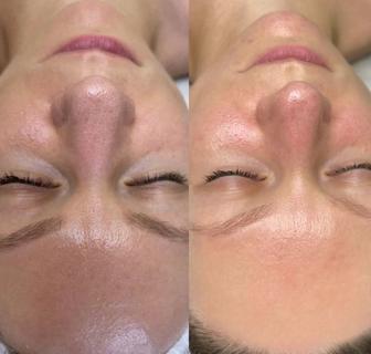 Чистка лица