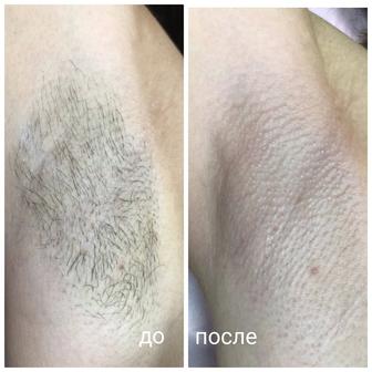 Шугаринг у вас на дому