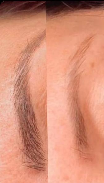 Акция на удаление лазером старого татуажа