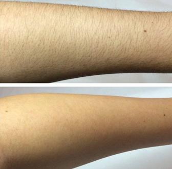 Восковая депиляция