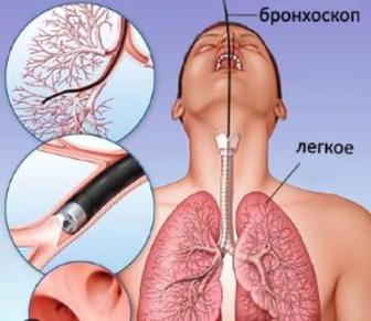 Услуга врача на дом бронхоскописта, ФБС, пульманолога, торокального хирурга