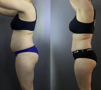 Аппаратный массаж