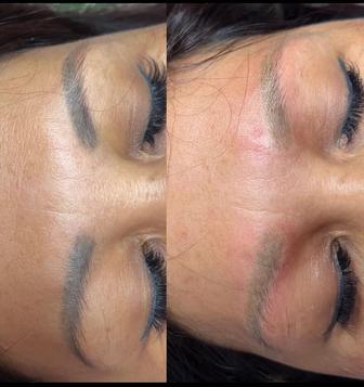 Лазерное удаление татуажа