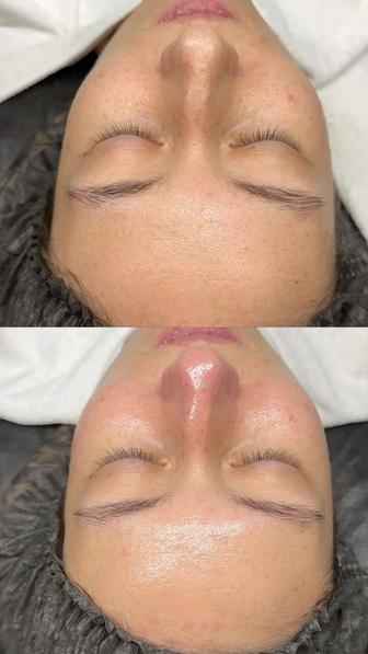 Пилинг процедура Vedara Medical