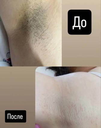 Шугаринг депиляция