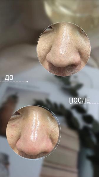 Касметолог Бет күтімі миканикалық тазалау