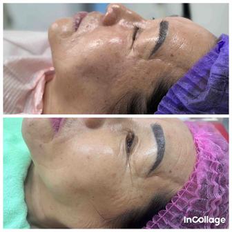 Микро игольчатый рф лифтинг