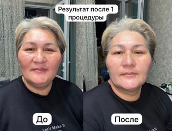 Аппаратный массаж лица, омоложение лица