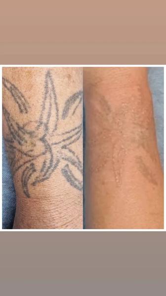 Удаление пм бровей, татуировок