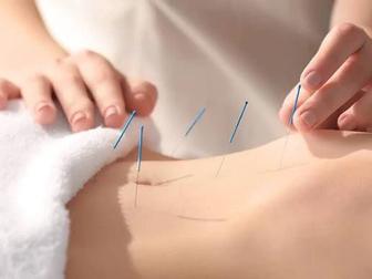 Иглоукалывание, иглотерапия, иглорефлексотерапия, акупунктура