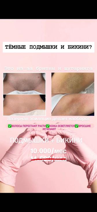 Лазерная эпиляция