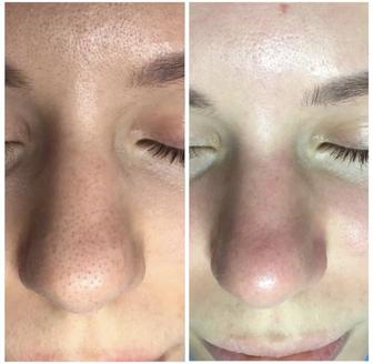 Комбинированная чистка лица